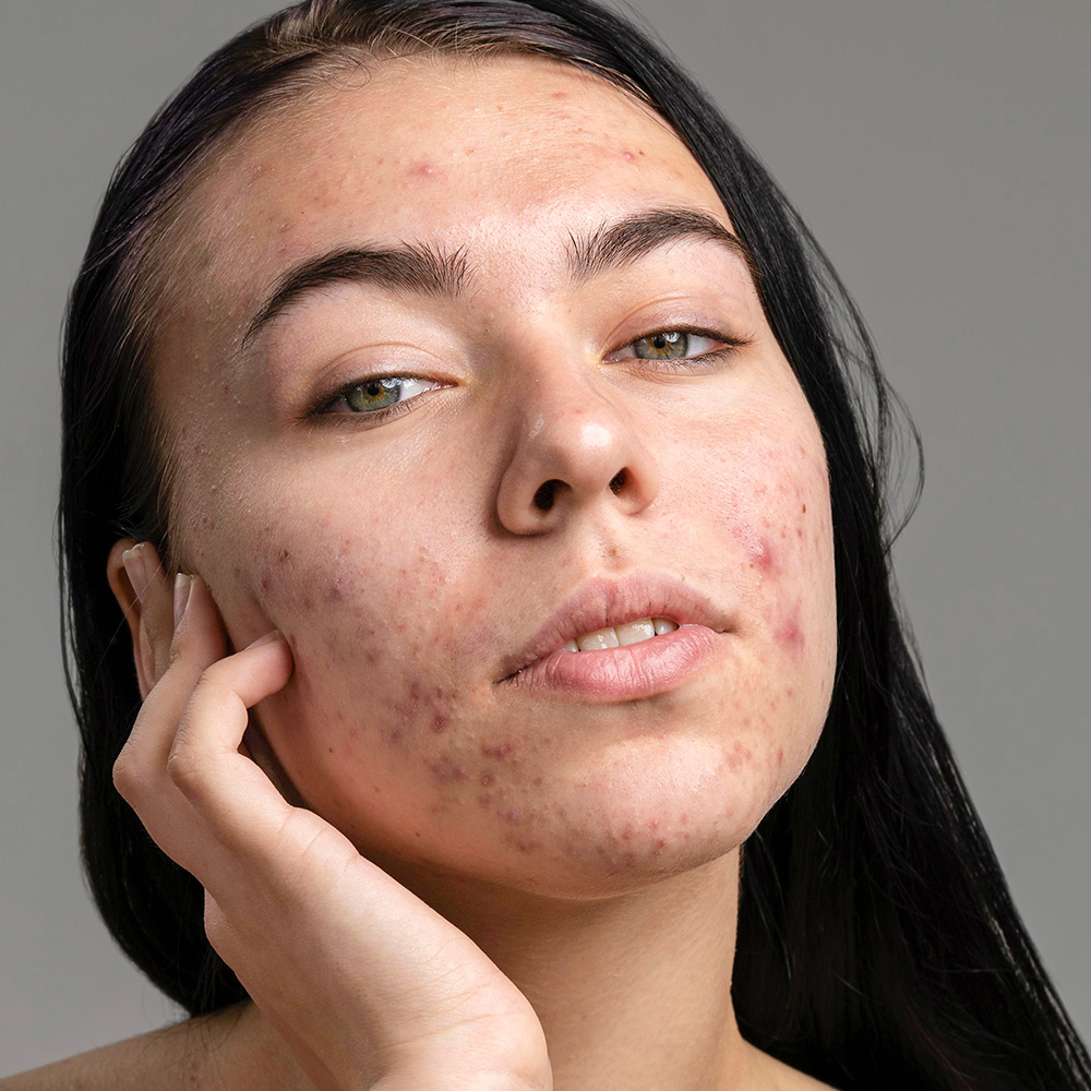 Young woman with dull broken out skin