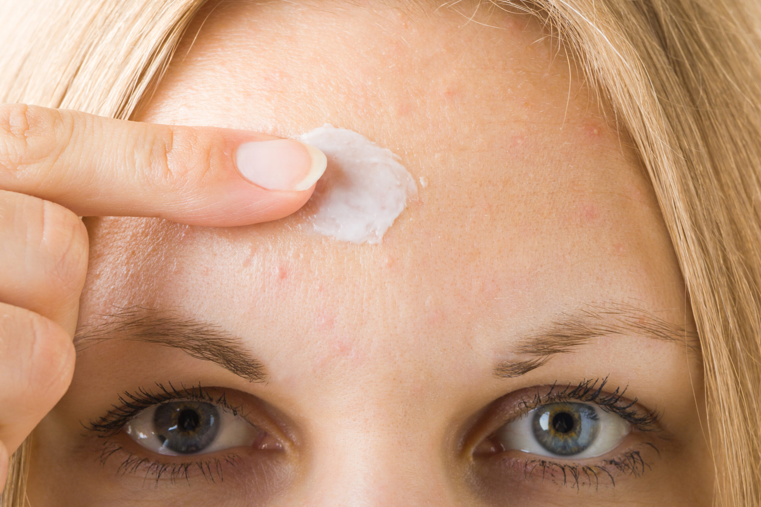 woman applying treatment to acne